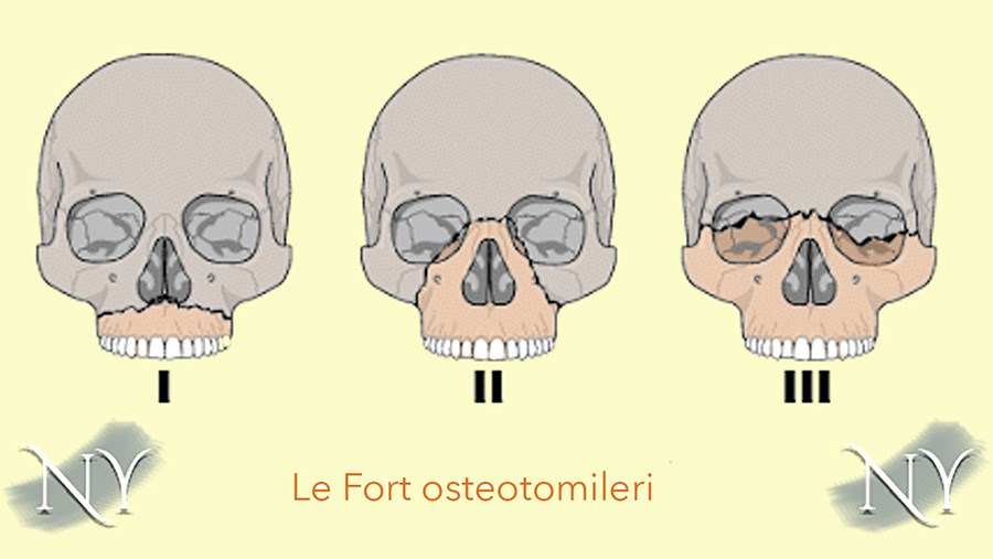 Le fort’a göre üst çene ve üst yüz ilerletme ameliyatı tipleri.