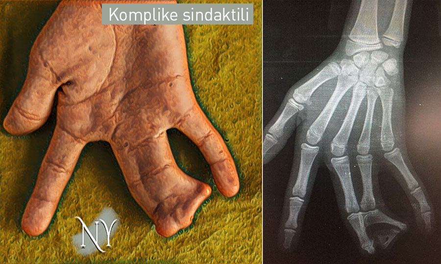 Sindaktili (Yapışık parmak) deformitesi