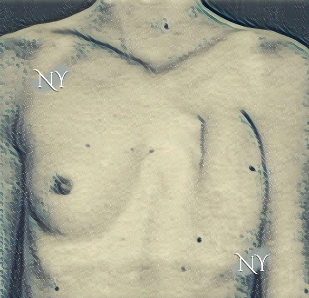 Poland sendromlu kadın hastada göğüs duvarı deformitesi ve memenin yokluğu.